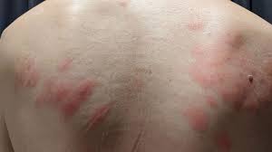 sea lice rash pictures symptomore