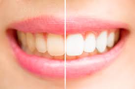 A common cause is dental fluorosis. Help Teeth Stained After Braces Thomas Orthodontics