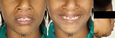 bilateral cleft lip and palate