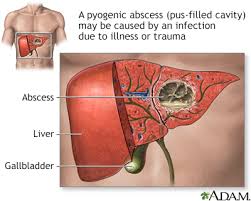pyogenic liver abscess information