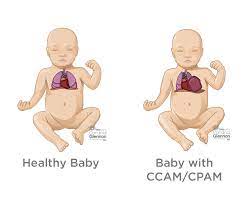 Lung cancer can and sometimes does occur during pregnancy. Fetal Lung Masses Diagnosis Treatments Expectancy Ssm Health