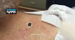 This is the biggest zit ever, and it has to be popped! Dr Pimple Popper The Biggest Blackhead In History
