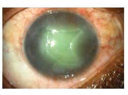 Herpes simplex keratitis: challenges in diagnosis and clinical managem |  OPTH