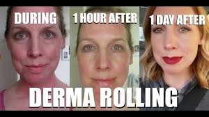 derma rolling step by step do s don