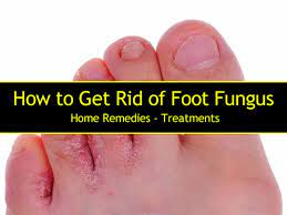 foot fungus home remes