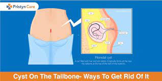 cyst on the tailbone ways to get rid