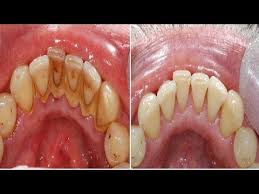 First, ½ tsp salt should be mixed with 1 cup of baking soda. How To Remove Plaque With A Tablespoon Of Baking Soda With Half A Teaspoon Of Salt With Toothbrush Soaked In Water Plaque Removal Health Teeth Cleaning Plaque