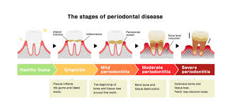 what damage can periodontal disease