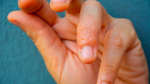 dyshidrotic eczema on the hands