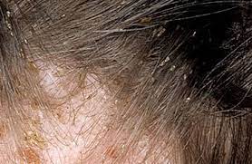 head lice oblique hair spa