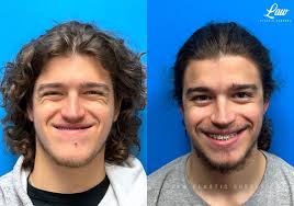 jaw surgery before after photos law