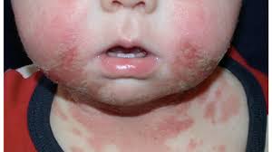 baby rash causes types treatments