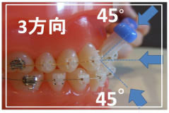 矯正治療中のブラッシング：歯の矯正治療について｜静岡市の矯正歯科・歯列矯正・歯の矯正・目立たない矯正なら矯正歯科サンクチュアリ
