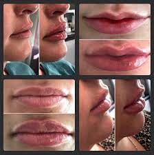 our new lip filler restylane kysse