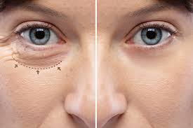 blepharoplasty surgery in mn