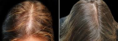 Find out more info about stem cell hair regrowth reviews on searchshopping.org for arlington. Stem Cell Hair Restoration Tampa Stem Cell Hair Therapy