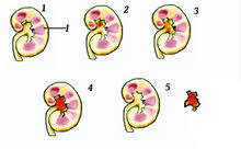 Kidney Stone Disease Wikipedia