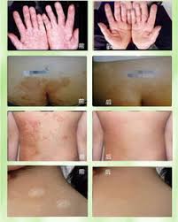 ТХЛФ ( yiganerjing ) против псориазис | дерматит | екзема | сърбеж | лишей  | обриви | гъбички | себореа | хемороиди
