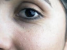 They are those black spots, specks, rings or cobwebs that drift aimlessly around in your field of vision. Milia Under Eyes Causes Diagnosis And Treatment