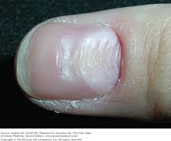 normal nail variants basiccal key