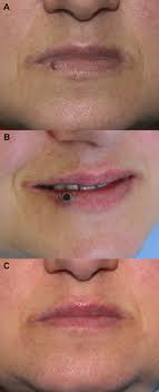 treatment of lip hemangioma using