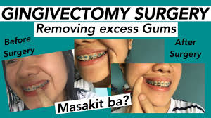 If your gingivitis is more serious, it could take longer to treat. My Gingivectomy Surgery Removing Inflamed Gums And Excess Gums Braces Youtube