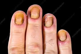 dystrophic finger nails stock image