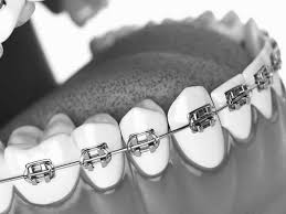 Three fantastic benefits of orthodontics. Emmanuel Total Dental Care Best Dental Service Providers In Cameroon