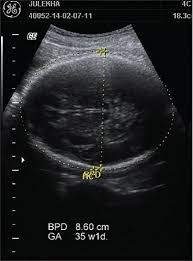 Assessment Of Fetal Gestational Age By Ultrasonic