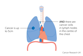 Stage 3 Lung Cancer Cancer Research Uk