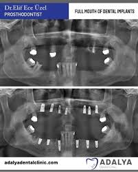 full mouth dental implants turkey