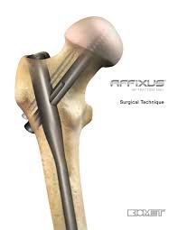 hip fracture nail surgical technique