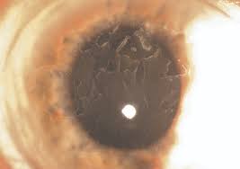 These deposits are not caused by inflammation, infection, or trauma, but by genetic mutations that lead to. Epithelial Basement Membrane Dystrophy American Academy Of Ophthalmology