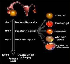 roadmap to evaluate ovarian cysts