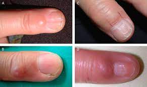 nail changes in myxoid cysts a