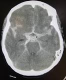 Image result for icd 10 cm code for intracerebral hemorrhage