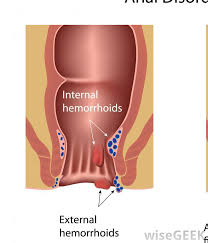 Maybe you would like to learn more about one of these? What Are Bleeding Hemorrhoids With Pictures