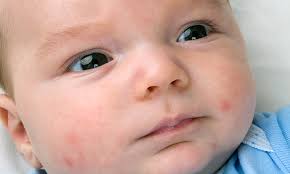 15 common baby rashes pers