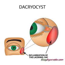 lacrimal cyst causes symptoms