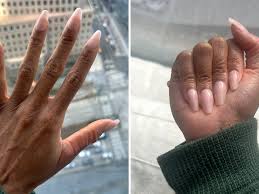 skin picking disorder through manicures