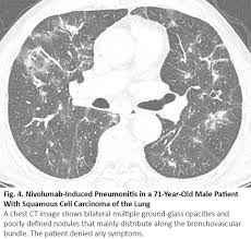 Ct Findings Of Covid 19 Pneumonia And