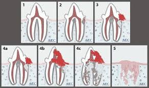 External Tooth Resorption In Catspart 2 Therapeutic