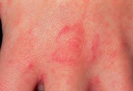 scabies treatment causes kids