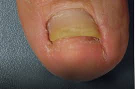 psoriasis nail repair kerasal