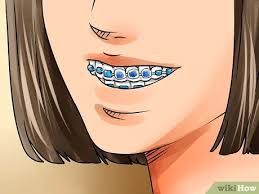 Then firmly press the softened wax against the area of the braces that is protruding or broken. How To Apply Dental Wax On Braces 12 Steps With Pictures