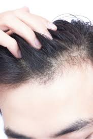 These benefits include beautiful skin and hair, increasing energy. Vitamin D Deficiency Hair Loss Symptoms And Treatment
