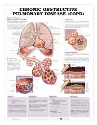 Copd Chronic Obstructive Pulmonary Disease Laminated Char Tlfa 99783