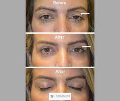 eyelid ptosis before and after gallery