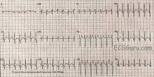 It is the most frequent abnormal heart rhythm in newborns and infants. Sinus Tach Or Svt 4 Clues To Tell The Difference