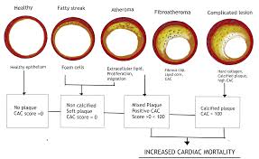cureus coronary artery calcium score